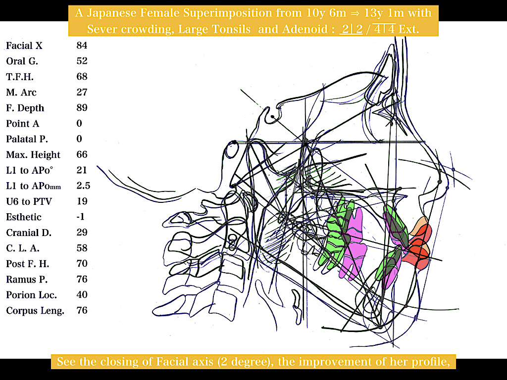 八王子 歯並び、八王子 矯正歯科